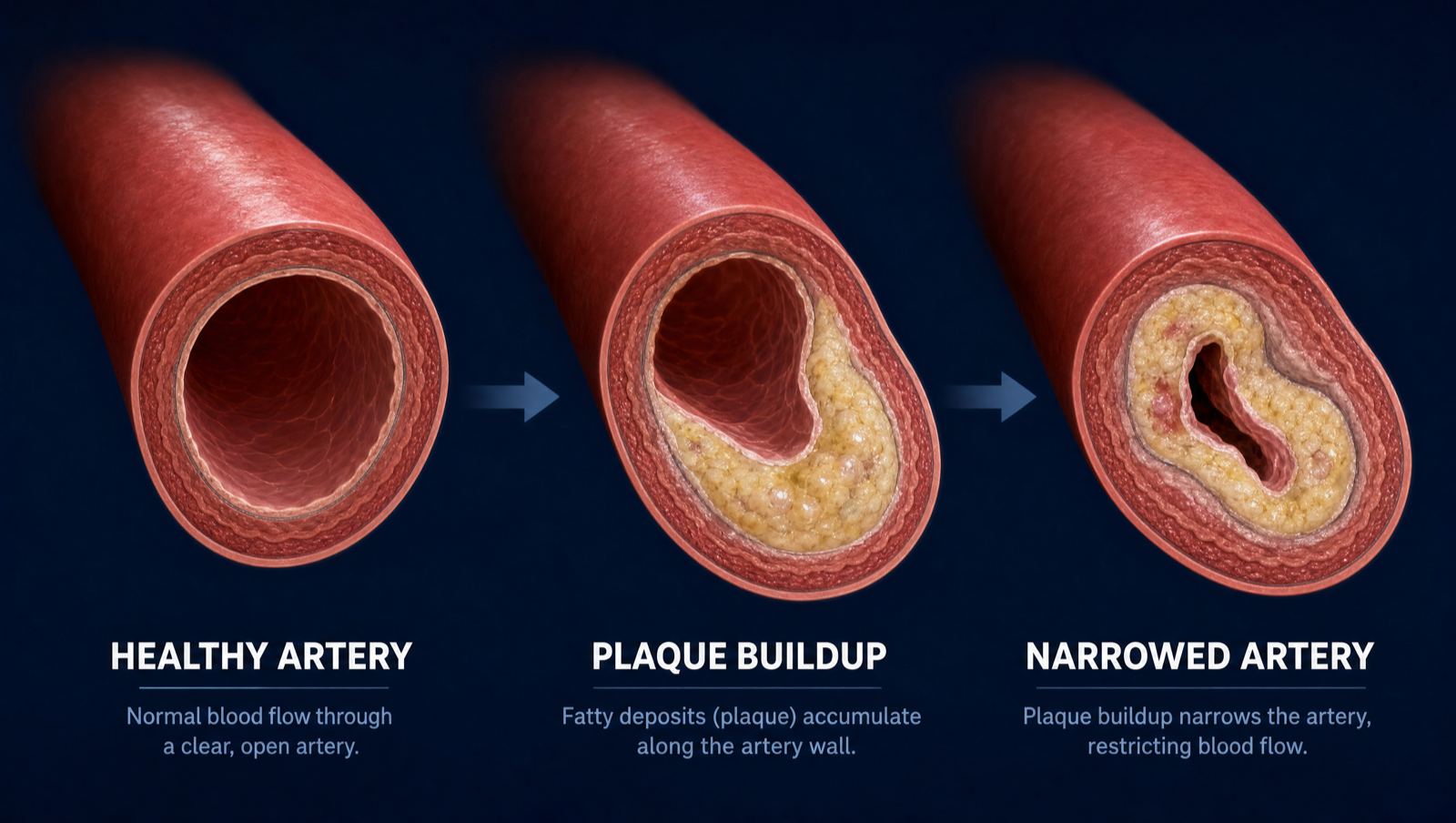 Three-stage medical illustration of arterial change: a healthy open artery, an artery with early plaque, and a narrowed artery.