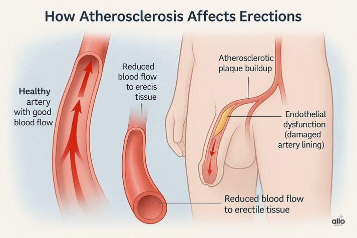 How atherosclerosis affects erections — healthy artery with good blood flow vs. atherosclerotic plaque buildup, endothelial dysfunction, and reduced blood flow to erectile tissue.