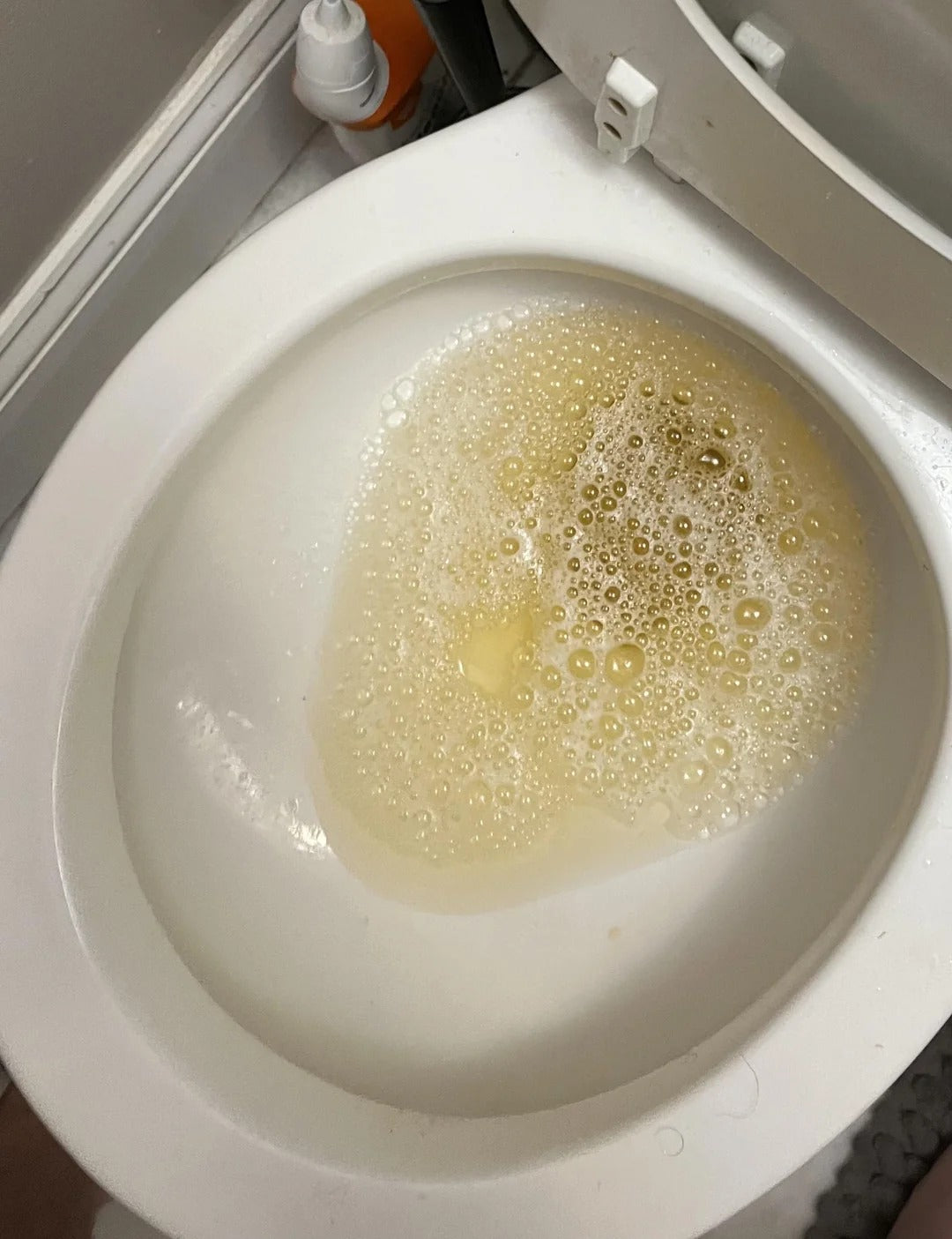 Foaming urine in a toilet bowl.