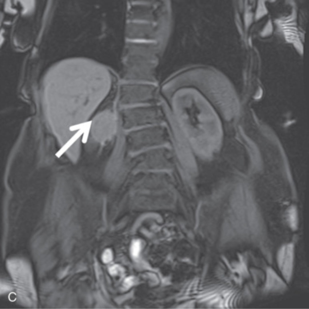Coronal MRI of the abdomen with an arrow marking a kidney.