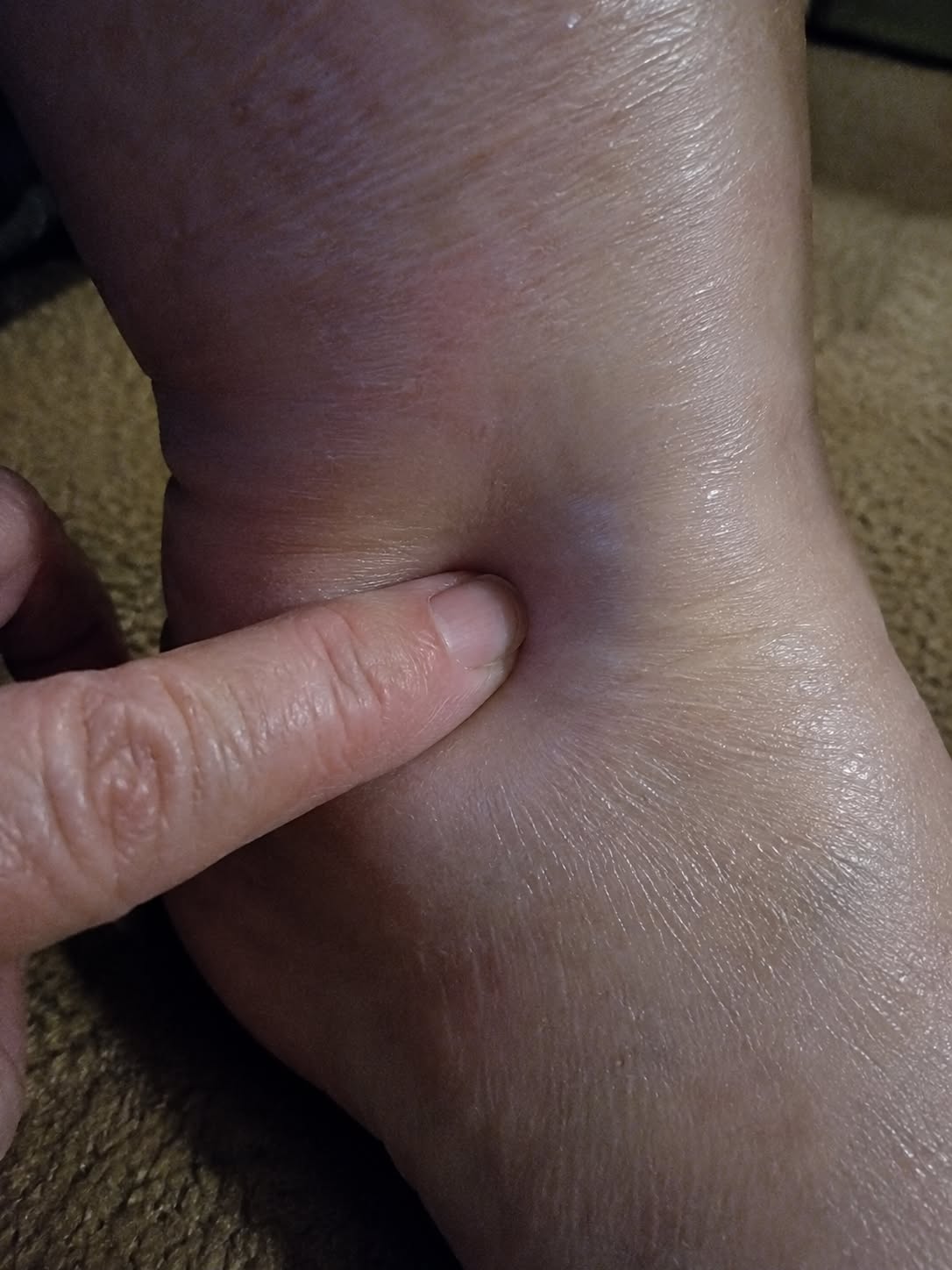 A finger pressing into a swollen ankle, leaving an indentation.