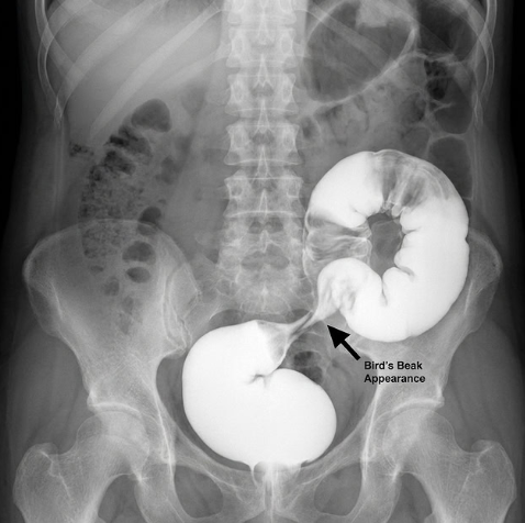 Abdominal X-ray showing a hugely dilated loop of bowel with a tapered bird's beak appearance, indicating sigmoid volvulus.