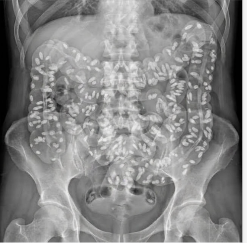 Abdominal X-ray from a colonic transit study showing dozens of white radiopaque markers still distributed throughout the colon days after ingestion.