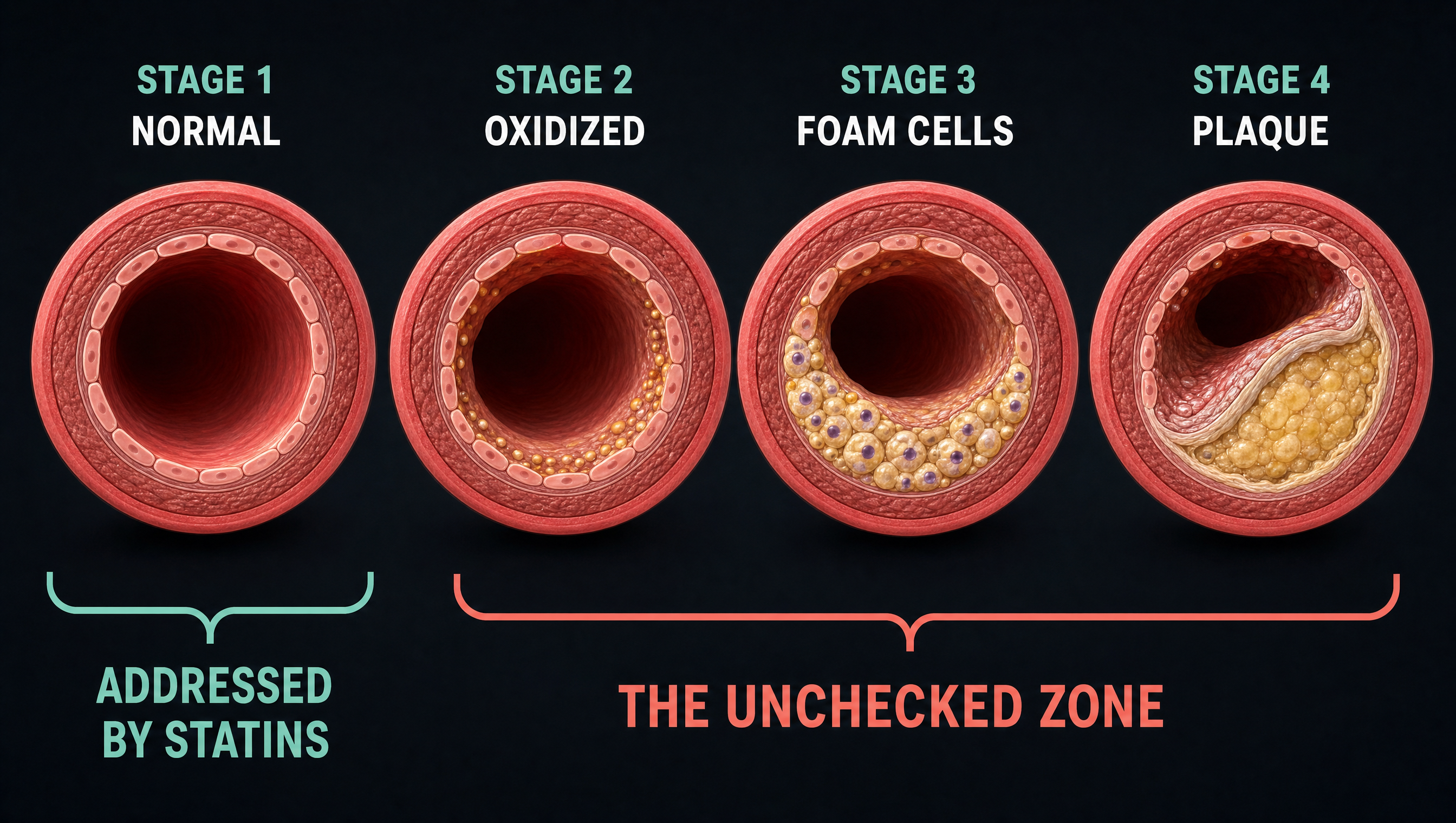 Four-stage diagram: healthy LDL, oxidized LDL, foam cell, and arterial plaque.