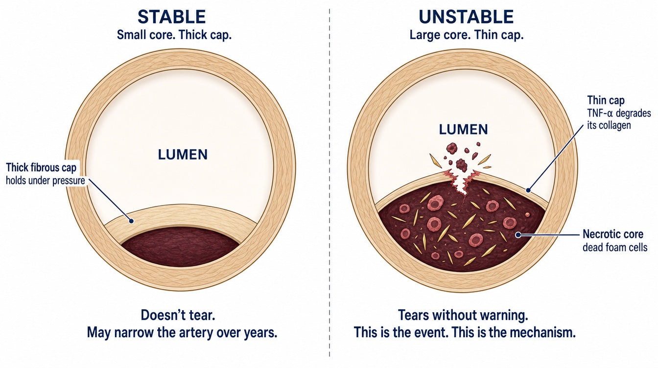 Two artery cross-sections: a stable plaque with a small dark necrotic core under a thick fibrous cap that holds, versus an unstable plaque with a large necrotic core full of cholesterol crystals and dead foam cells under a thin cap that has torn open into the lumen.
